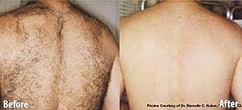 Laser Hair Removal (LHR)